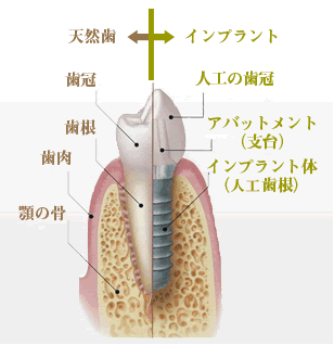 インプラント＝天然歯根の代用となる人工の歯根
